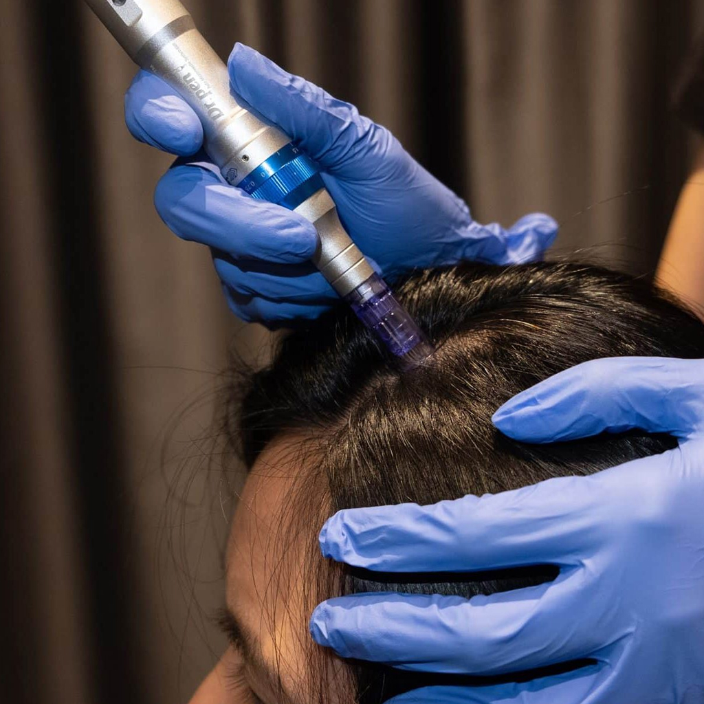 Hair Restoration Treatment